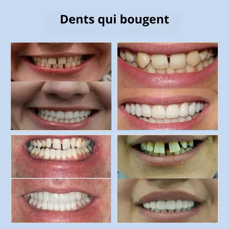 Prothèse Dentaire Complète